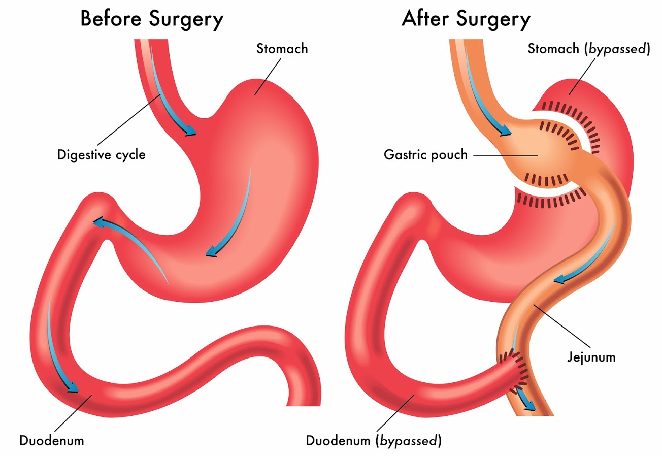 Before and after bariatric surgery illustration